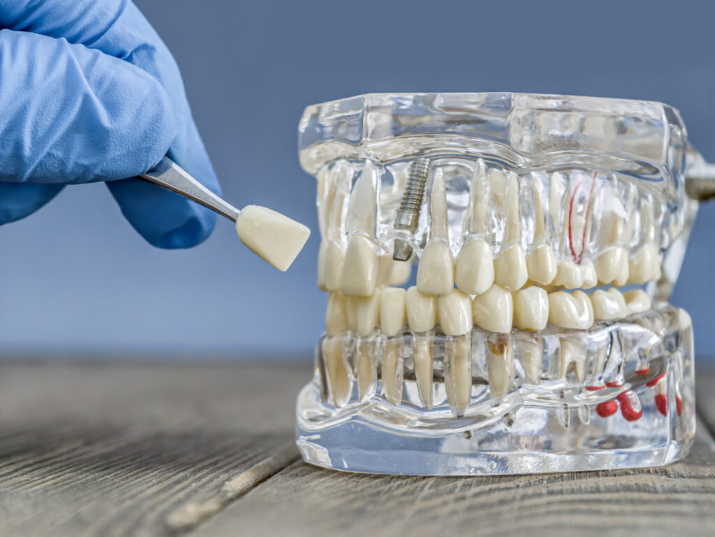 Detailed Transparent Dental Implant Model with Tweezers Holding a Prosthetic