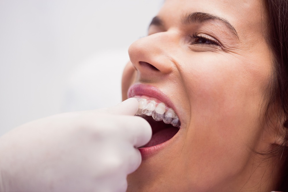 Clear Aligners Dubai – A Modern Way to Straighten Your Smile